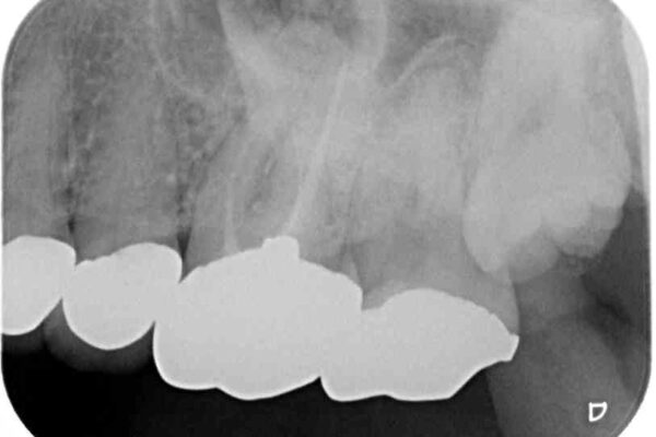 インプラントや歯周外科処置を用いた奥歯の補綴治療 治療前画像