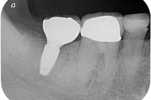 インプラントや歯周外科処置を用いた奥歯の補綴治療 アフター