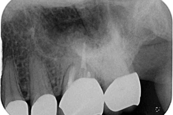 インプラントや歯周外科処置を用いた奥歯の補綴治療 治療後画像