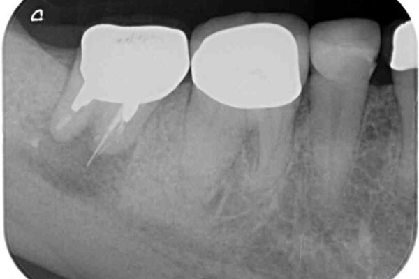 インプラントや歯周外科処置を用いた奥歯の補綴治療 治療前画像