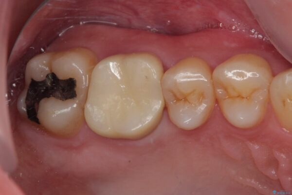 歯が割れた　オールセラミッククラウン 治療後画像