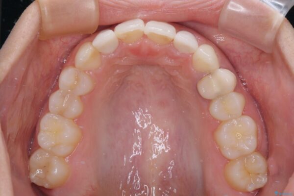 【モニター】前歯の変色とデコボコを改善　インビザラインとオールセラミック 治療後画像