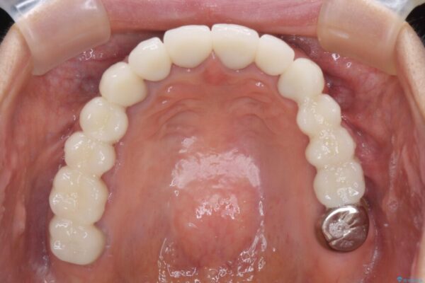 以前治療した歯がボロボロに　全顎補綴治療 治療後画像