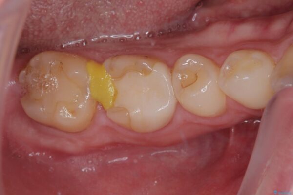 セラミックの詰め物が欠けたのでやり替えたい　オールセラミッククラウン 治療前画像