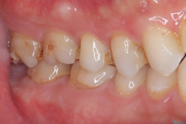 セラミックの詰め物が欠けたのでやり替えたい　オールセラミッククラウン 治療前画像
