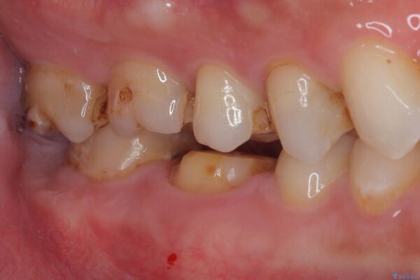 セラミックの詰め物が欠けたのでやり替えたい　オールセラミッククラウン 治療途中画像