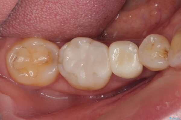 食べ物が引っかかるからやり替えたい　セラミックインレー修復 治療後画像