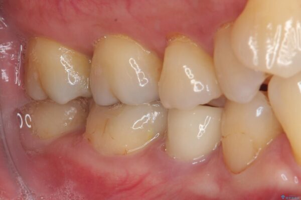 食べ物が引っかかるからやり替えたい　セラミックインレー修復 治療後画像