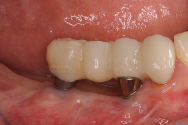 以前治療した歯がボロボロに　全顎補綴治療 治療前画像