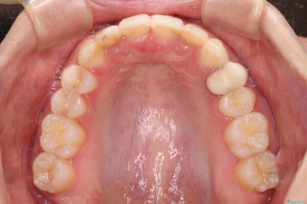 【モニター】前歯の変色とデコボコを改善　インビザラインとオールセラミック 治療途中画像