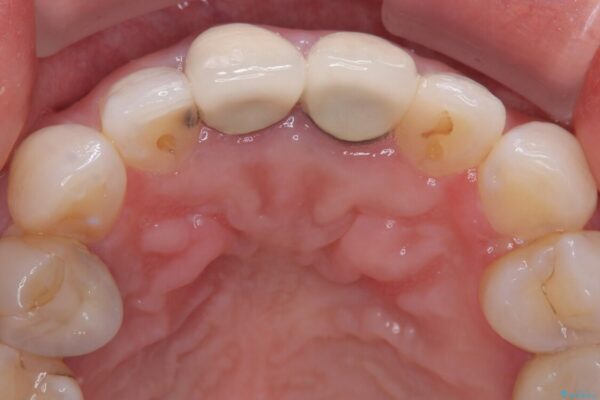 前歯の黄色味が気になる　オールセラミッククラウン 治療前画像