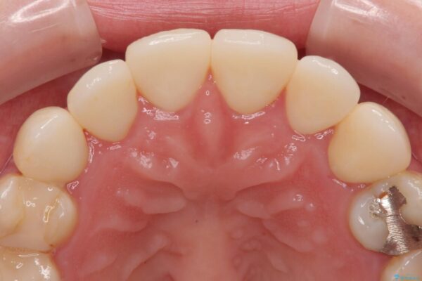 上の前歯の色味が気になる　オールセラミッククラウン　 治療後画像