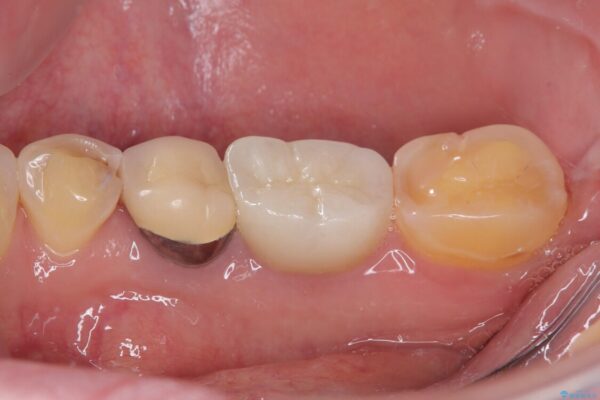 検診で見つかった齲蝕のセラミックインレー修復 治療前画像