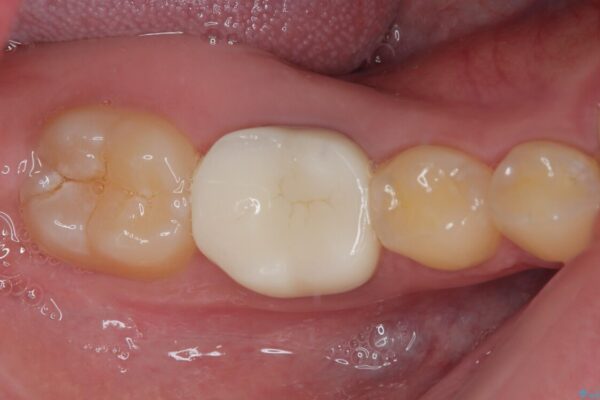 銀歯を白くしたい　オールセラミッククラウン 治療後画像