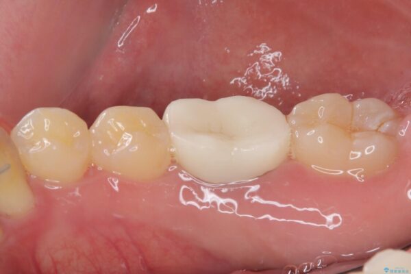 銀歯を白くしたい　オールセラミッククラウン 治療後画像