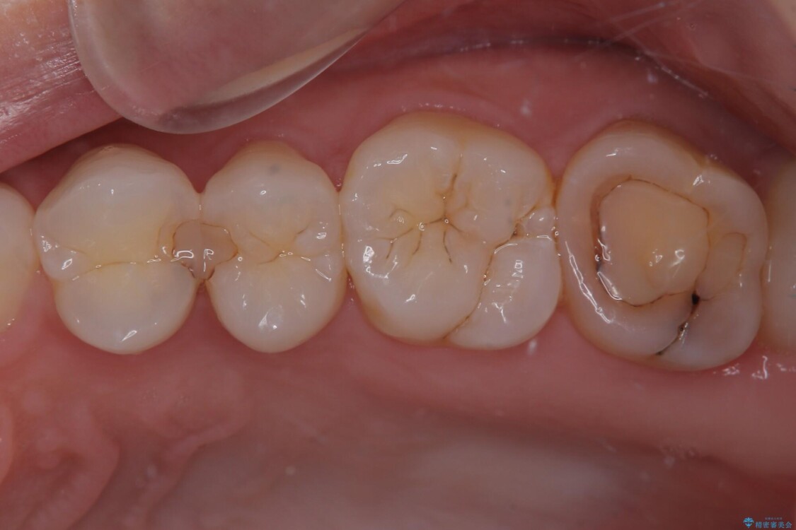 左上がしみて痛い　セラミックインレー修復 治療前