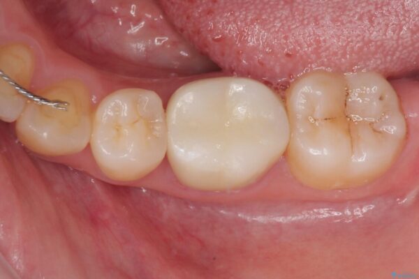 銀歯のところがしみる　オールセラミッククラウン 治療後画像