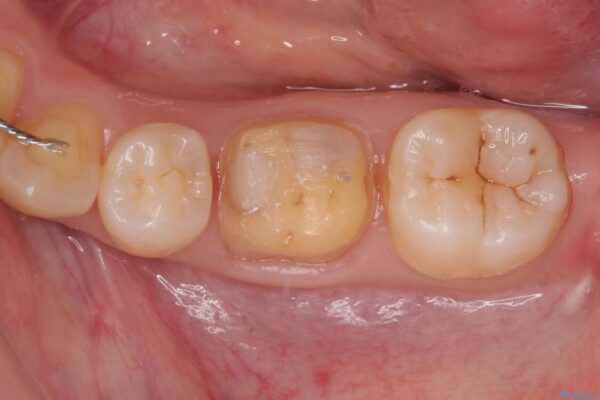 銀歯のところがしみる　オールセラミッククラウン 治療途中画像