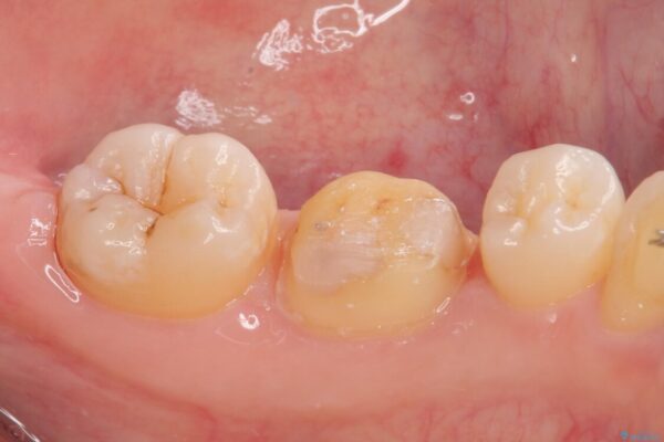 銀歯のところがしみる　オールセラミッククラウン 治療途中画像