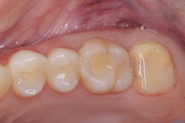 詰め物の下に虫歯があると言われた　オールセラミッククラウン 治療途中画像
