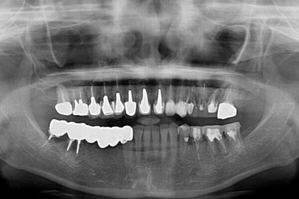 以前治療した歯がボロボロに　全顎補綴治療 治療前画像