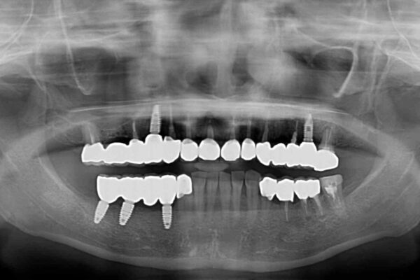 以前治療した歯がボロボロに　全顎補綴治療 治療後画像