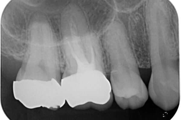 金属の詰め物が取れた。セラミックを入れたい!　オールセラミッククラウン 治療後画像