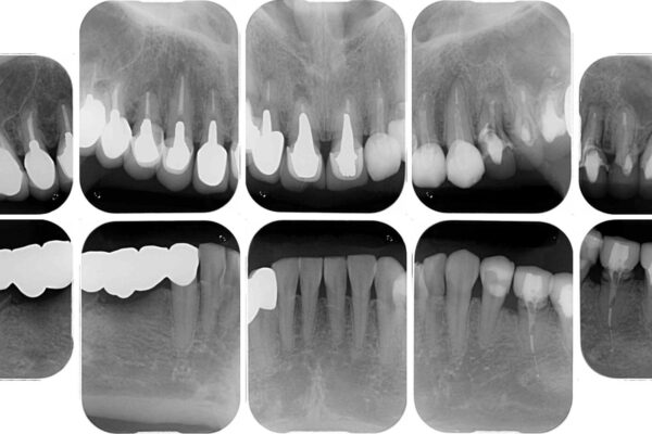 以前治療した歯がボロボロに　全顎補綴治療 治療前画像