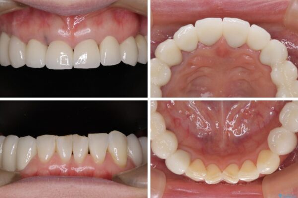 以前治療した歯がボロボロに　全顎補綴治療 治療後画像