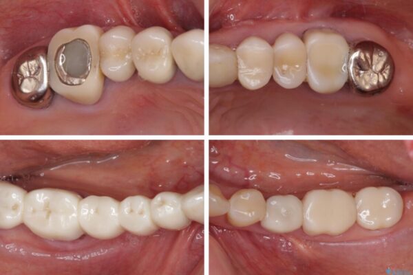 以前治療した歯がボロボロに　全顎補綴治療 治療前画像