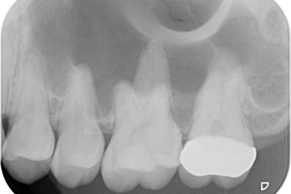詰め物の下に虫歯があると言われた　オールセラミッククラウン 治療後画像