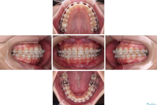 歯をきれいにしたい　ワイヤー矯正治療と虫歯治療 治療途中画像
