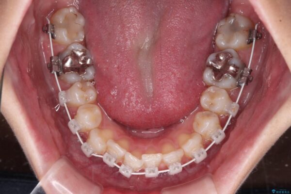 歯をきれいにしたい　ワイヤー矯正治療と虫歯治療 治療途中画像