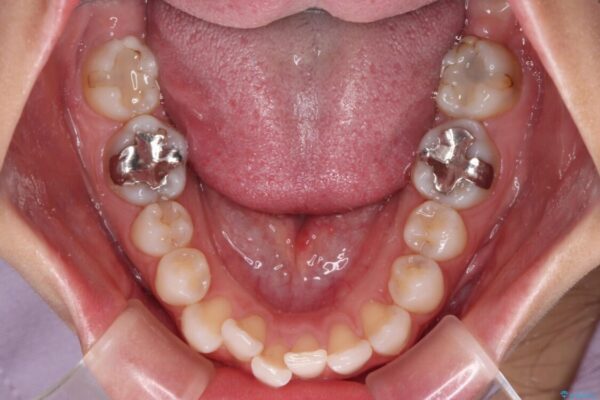 歯をきれいにしたい　ワイヤー矯正治療と虫歯治療 治療前画像