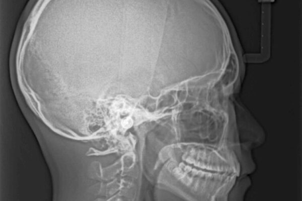 前歯の隙間とデコボコを改善　高校生のインビザライン治療 治療後画像