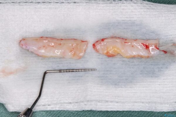 薄くて退縮しやすい前歯の歯肉　補綴治療前に歯肉移植で退縮しにくく 治療前画像