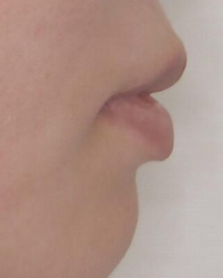 口元の突出感を改善したい。審美装置による抜歯矯正 治療前画像