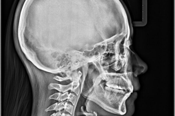 口元の突出感を改善したい。リンガルアーチを併用した抜歯矯正 治療後画像