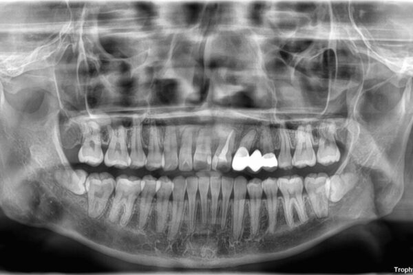 全体的なデコボコが気になる。拡大装置を併用したワイヤー矯 治療後画像