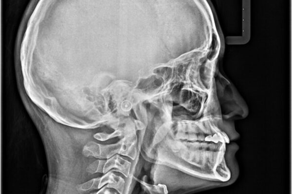 全体的なデコボコが気になる。拡大装置を併用したワイヤー矯 治療後画像