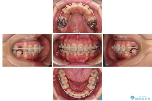 口元の突出感を改善したい。リンガルアーチを併用した抜歯矯正 治療途中画像