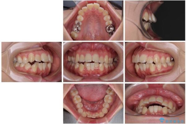 口元の突出感を改善したい。リンガルアーチを併用した抜歯矯正 治療前画像