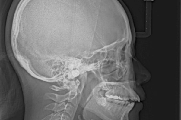 口元の突出感を改善したい。リンガルアーチを併用した抜歯矯正 治療前画像
