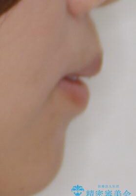 口元の突出感を改善したい。リンガルアーチを併用した抜歯矯正 治療前画像