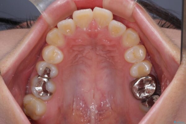 口元の突出感を改善したい。リンガルアーチを併用した抜歯矯正 治療前画像