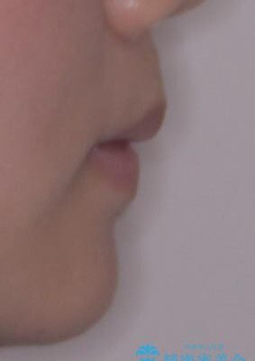 口元の突出感を改善したい。リンガルアーチを併用した抜歯矯正 治療後画像
