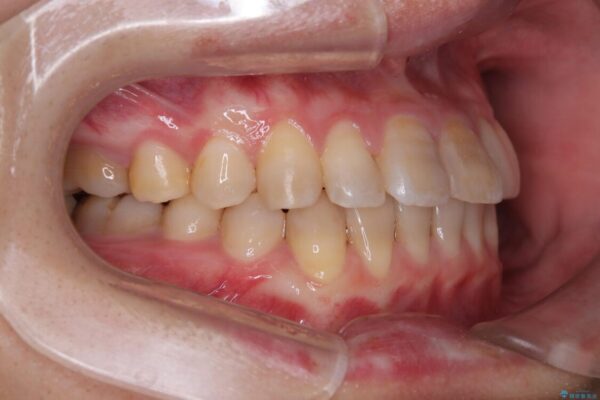 全体的なデコボコが気になる。拡大装置を併用したワイヤー矯 治療後画像