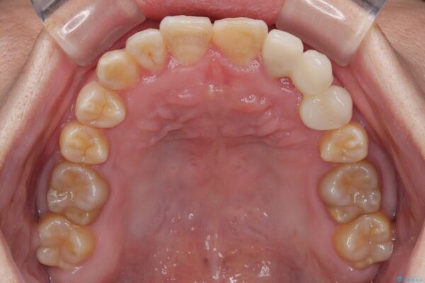 全体的なデコボコが気になる。拡大装置を併用したワイヤー矯 治療後画像