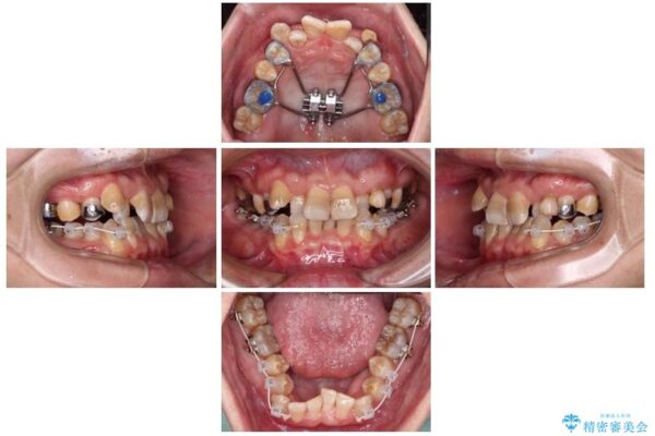 全体的なデコボコが気になる。拡大装置を併用したワイヤー矯 治療途中画像