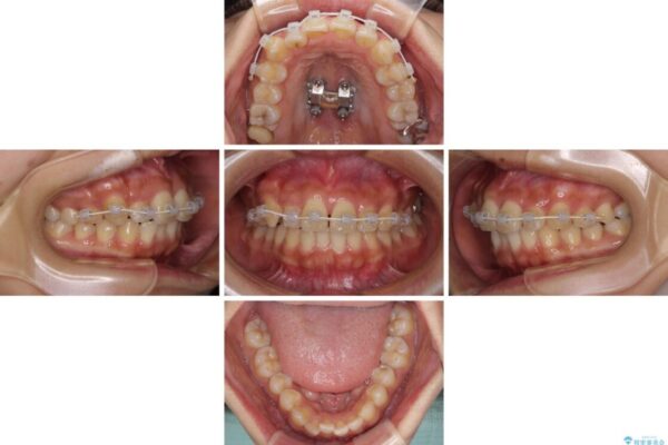 【モニター】歯列が狭くデコボコが気になる　急速拡大装置を用いたインビザライン矯正 治療途中画像